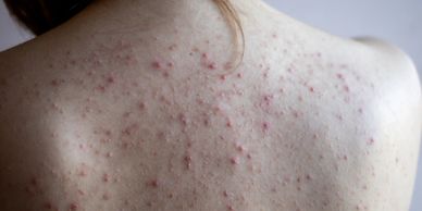 Close-up of a person's back with acne and red blemishes.