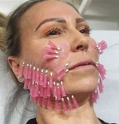 Lady with PDO threads inserted in face