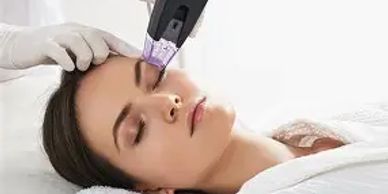 morpheus8 rf microneedling treatment being undertaken on lady's face with derma2 medical grade serum