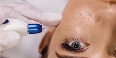 plasma fibroblast treatment making small burns and micro channels in a person's skin for skin liftin
