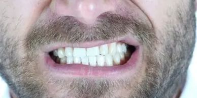 man grinding his teeth due to bruxism