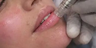 lips being micro needles using stayve cherri lips colour blush for lips