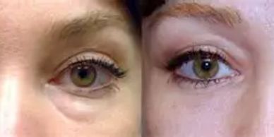 lady showing before and after treatment for fluid filled eye bags.