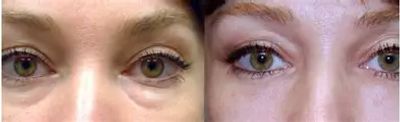 fluid filled eyebags and dark eye circles / dark circles