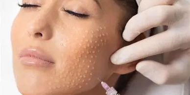 face being injected with skin booster or polynucleotides showing a mesotherapy technique with little