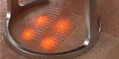 co2 laser skin tightening and skin lifting treatment being completed on someone's face