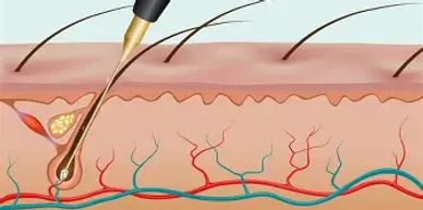 Electrolysis probe entering the follicle to remove hair