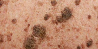 seborrheic keratosis skin lesions