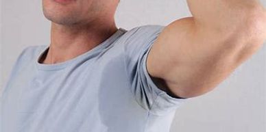 excessive under arm sweating or hyperhidrosis causing big sweat patches