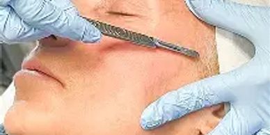 a sterile knife being used on a lady's face to remove the peach fuzz or soft hair by dermaplaning
