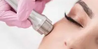 Lady having microdermabrasion on her face to exfoliate, treaacne scars and rejuvenate skin