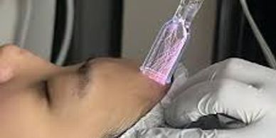 person having cold plasma therapy for a medical or aesthetic skin care need