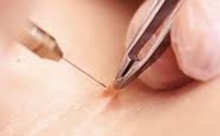 Close-up of a needle injecting into skin with tweezers nearby.