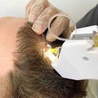 mesotherapy hair restoration treatment