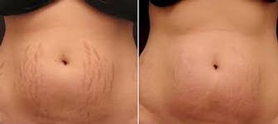 Before and after of plasma fibroblast treatment on abdominal stretch marks