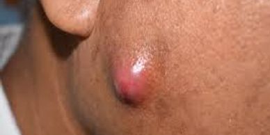 Big pimple cyst on a man's face