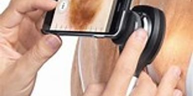 specialised camera and dermatoscope being used to assess skin lesions  for different types of skin c
