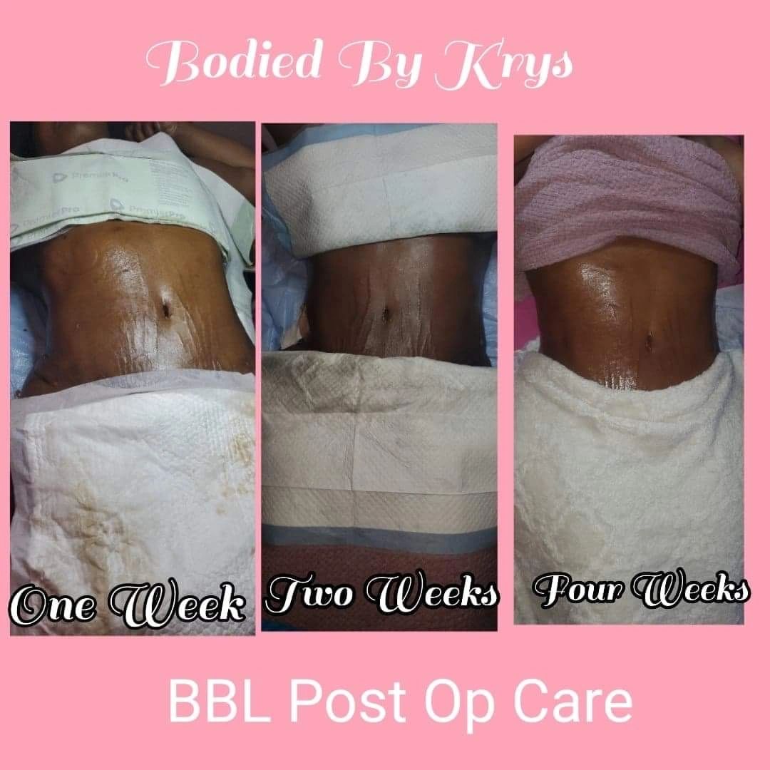 BBL Post Op lymphatic Massage