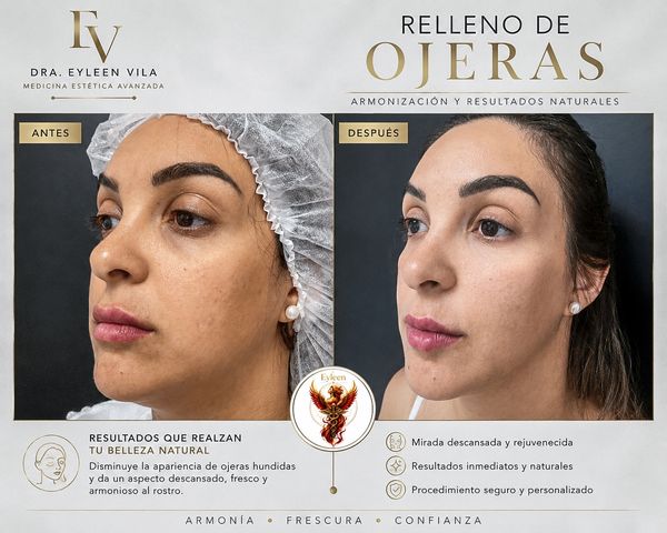 Comparación de antes y después de rellenar ojeras.