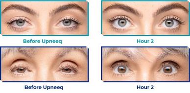 Before and after images showing wider lids after Upneeq Use