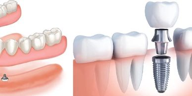 Implants and Implant Dentures
