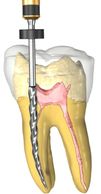 Root Canals Endodontics