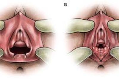 perineoplasti perinoplasti