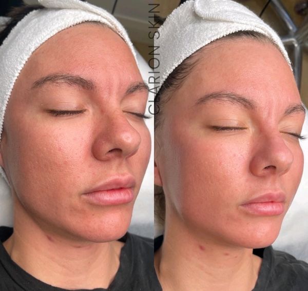 Before and after lifting and clearing skin on woman’s face. Cromer, Northern Beaches, Sydney
