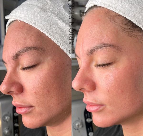 Before and after Hydra Facial and HIFU. Anti Ageing. Face Lifting. Cromer, Northern Beaches, Sydney