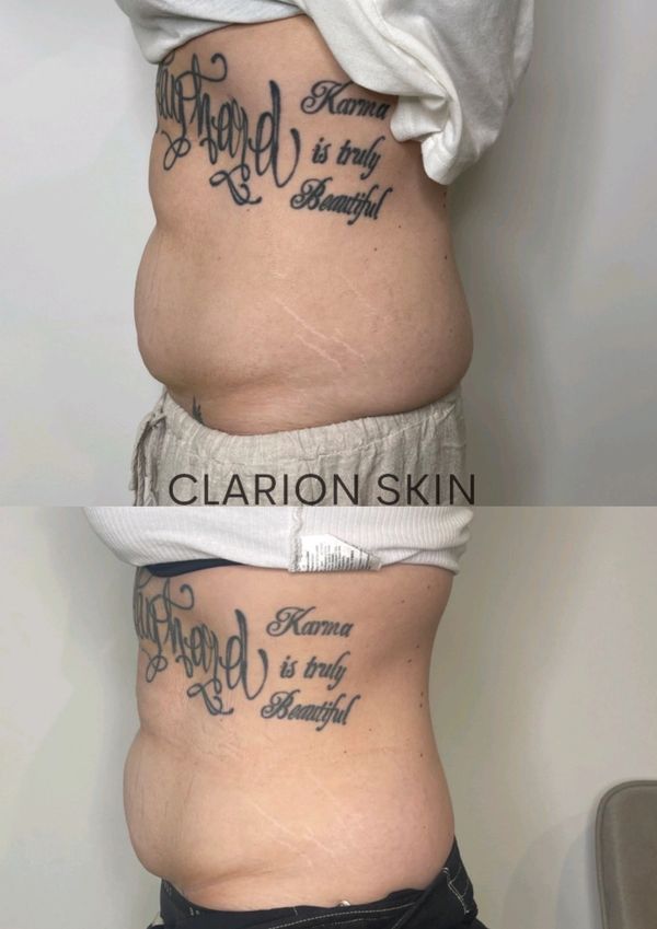 Before and after side of stomach after Fat reduction and skin tightening treatment