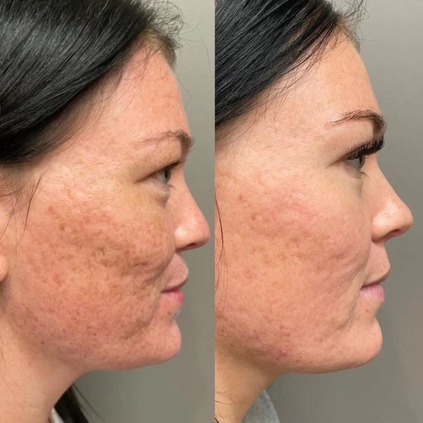Scar reduction treatment. RF needling, RF Microneedling. Cromer, Dee Why, Northern Beaches 