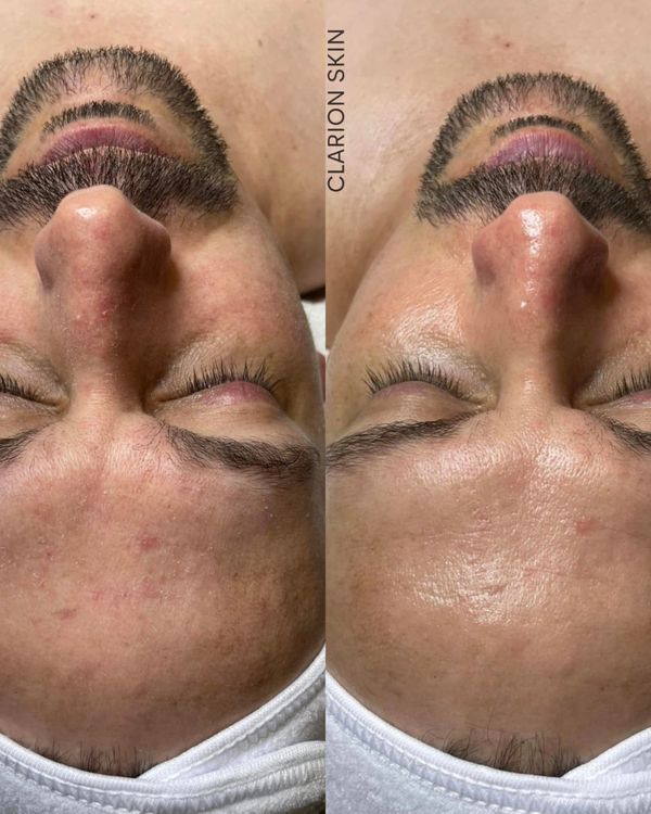 Men's facial. Hydra Facial. Cromer, Northern Beaches 