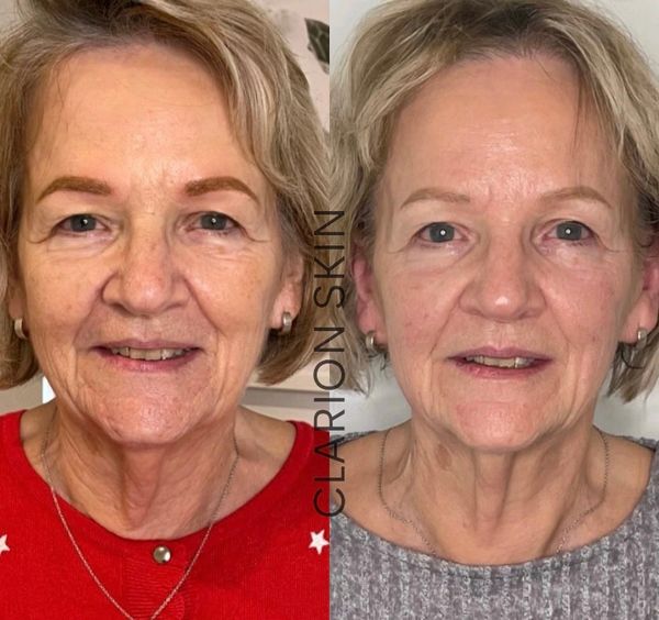 Before and after lifting and tightening treatment, HIFU in older lady 