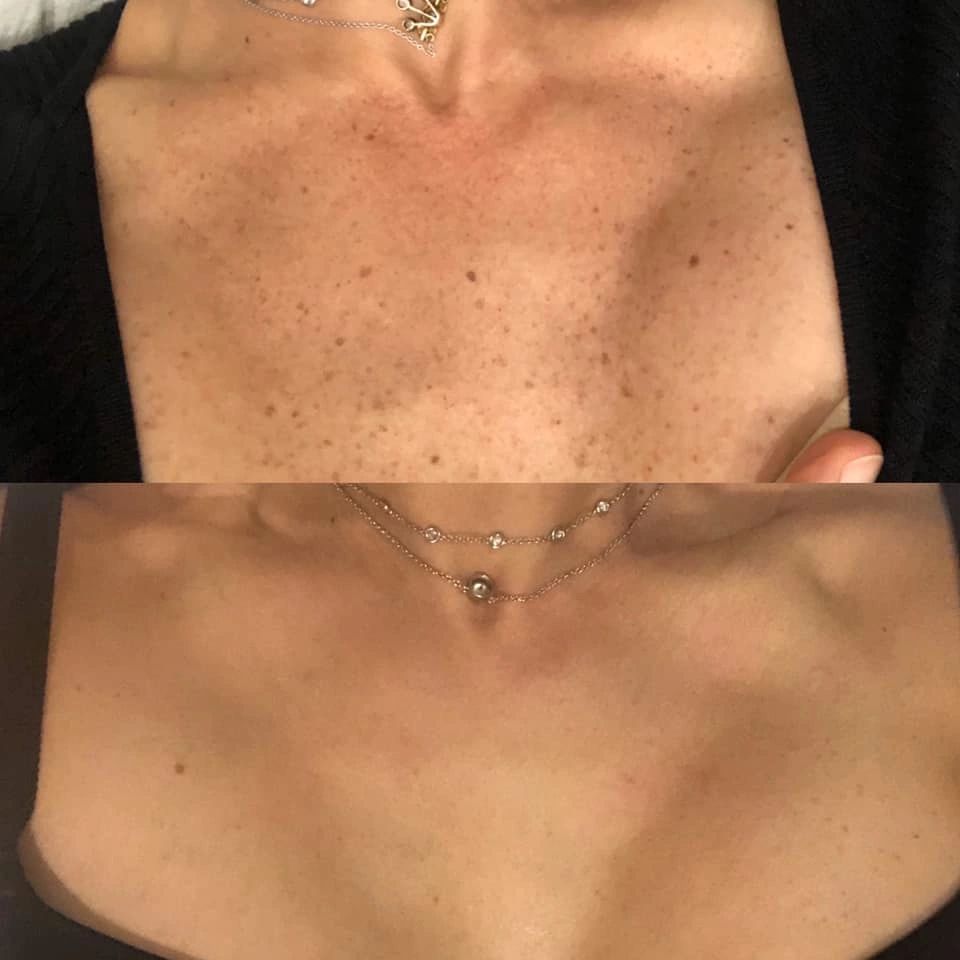 Dr. Katherine Coley was treated with Lumecca, IPL, in December 2019. The results are amazing!