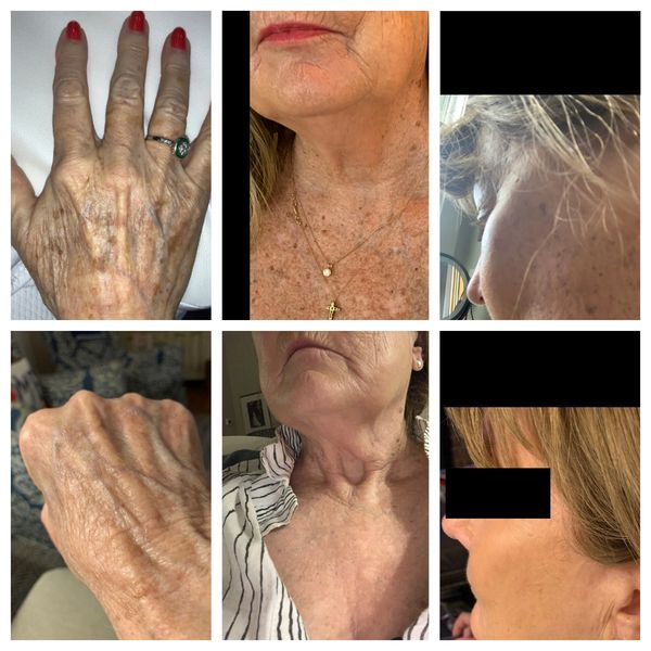 InMode Lumecca. Phenomenal results 10 days after treatment. 