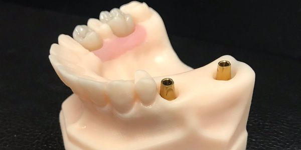 3D Printed dental models and implant crowns