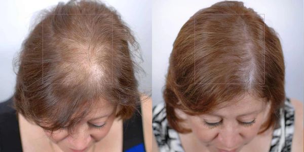 Nutrafol, hair growth, hair supplement, thinning hair, Rogaine, Wilmington, NC