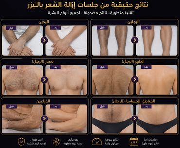 صور قبل وبعد تظهر نتائج إزالة الشعر بالليزر لأجزاء مختلفة من الجسم.