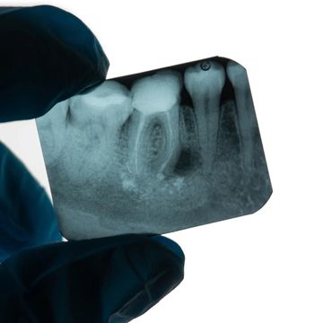 root canal
