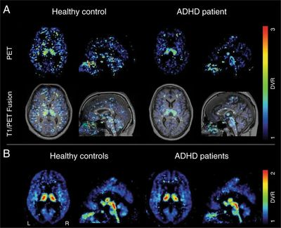 Brain imaging of normal versus ADHD patient