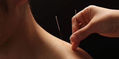 shoulder acupuncture in hastings 