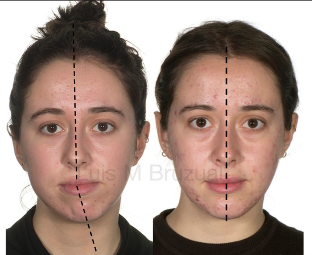 Images before and after surgical correction of facial asymmetry