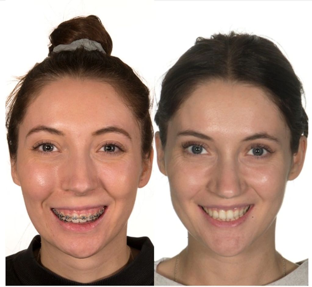 Anterior facial views, before and after of correction of gummy smile (Vertical maxillary excess) 