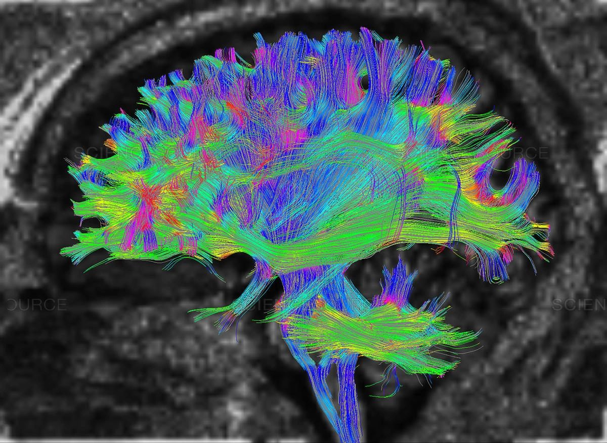 Diffusion Tensor Mri Imaging And Fiber Tractography 8113