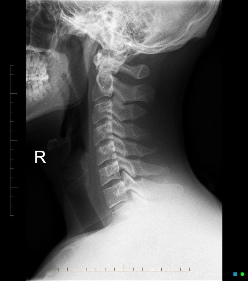unstable cervical spine x rays