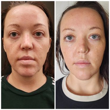 Before & after 2 Jet Plasma sessions. Jaw is defined, skin appears toned, complexion is bright.
