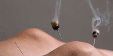 Moxibustion with moxa attached to the needle. British Acupuncture Council.