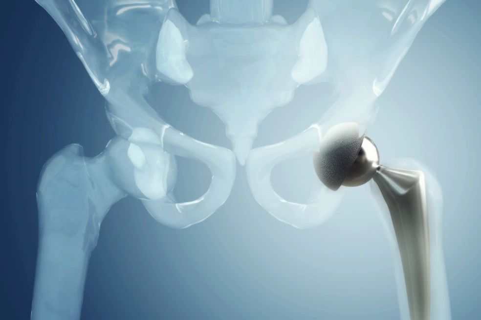 Hip replacement 