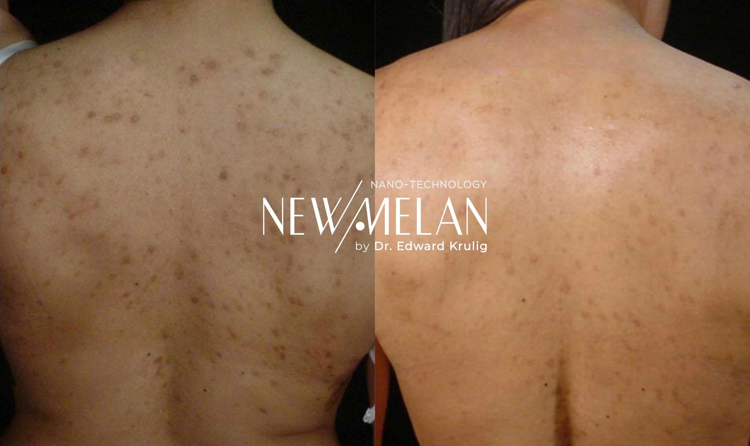 Hiperpigmentación Postinflamatoria y Postacné, image size:2560x1524