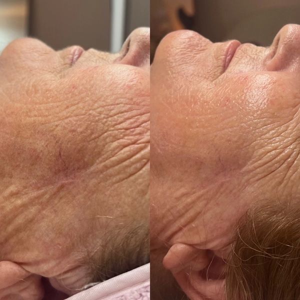 Side-by-side close-up of facial skin showing reduced wrinkles and smoother texture.